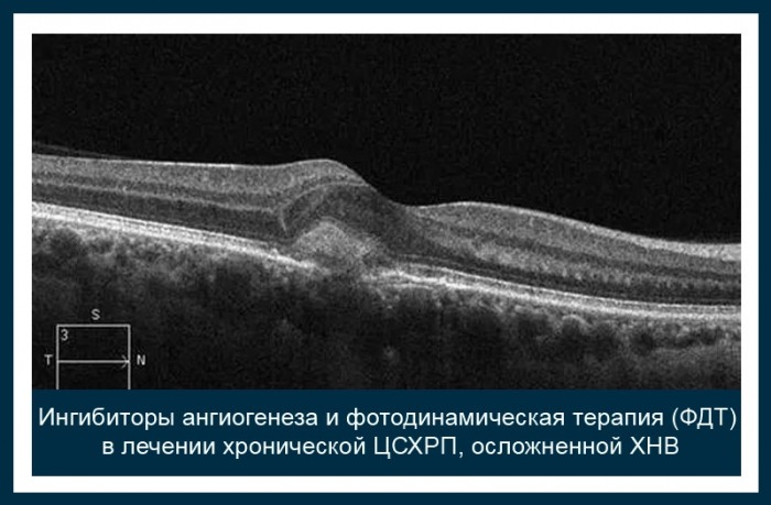 ингибиторы ангиогенеза препараты.