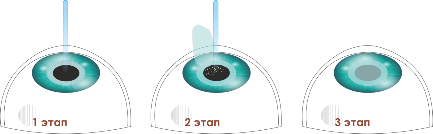 Лазерная коррекция зрения методом FemtoLASIK ФемтоЛАСИК Спб клиника Зрение офтальмологический центр на Добролюбова, 20к1