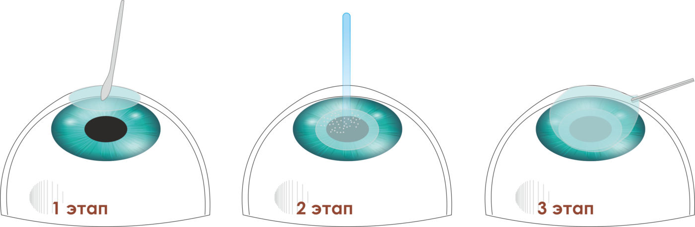 Лазерная коррекция зрения методом ФРК (фоторефрактивная кератэктомия) Спб клиника Зрение офтальмологический центр на Добролюбова, 20к1