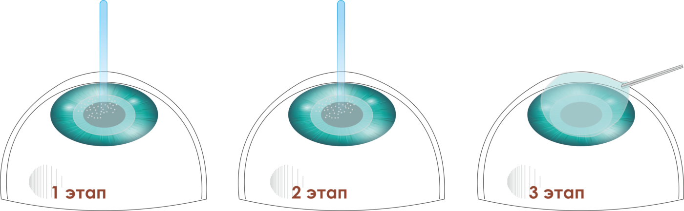 Лазерная коррекция зрения методом ТрансФРК трансФРК (трансэпителиальная фоторефрактивная кератэктомия) Спб клиника Зрение офтальмологический центр на Добролюбова, 20к1