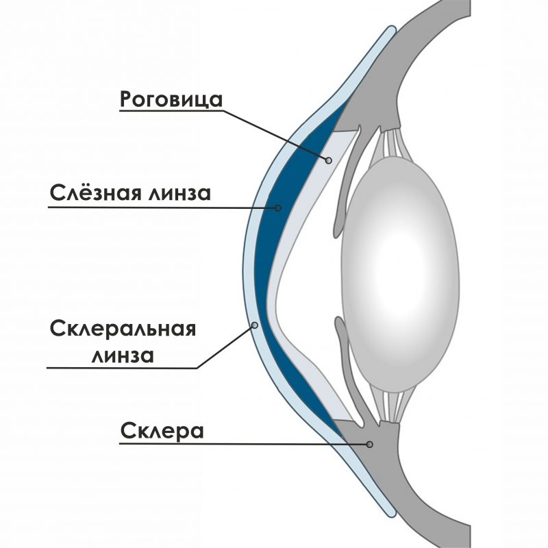 Жесткие газопроницаемые склеральные контактные линзы