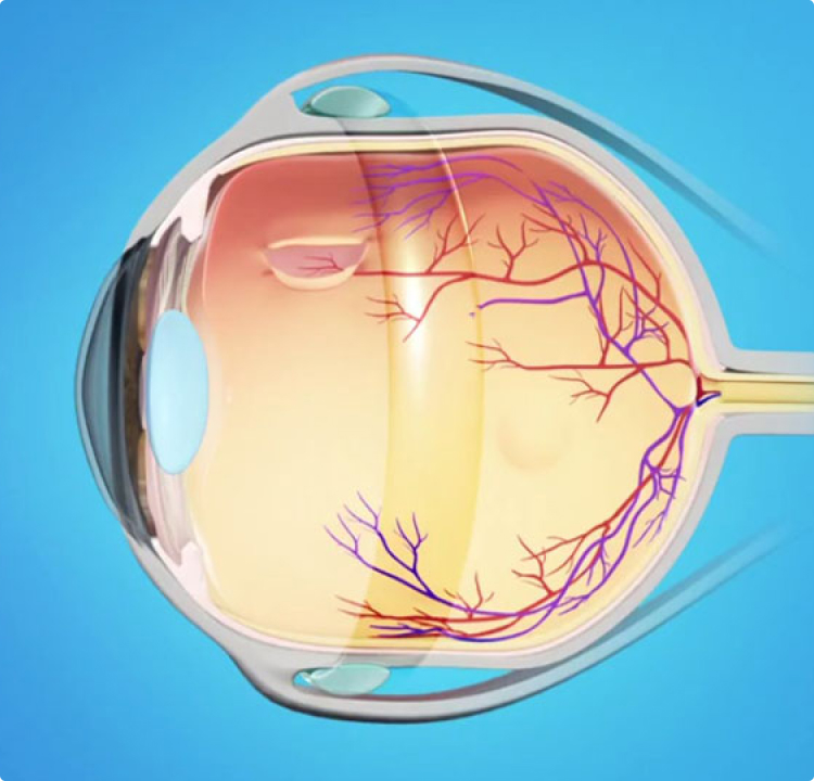 Пломбирование сетчатки. Диабетическая ретинопатия сетчатки. Отслоение сетчатки - ретинопатия.. Эписклеральное пломбирование сетчатки.