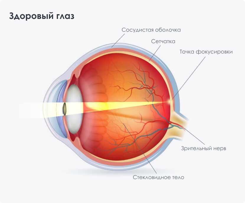 Методы замедления прогрессирования близорукости