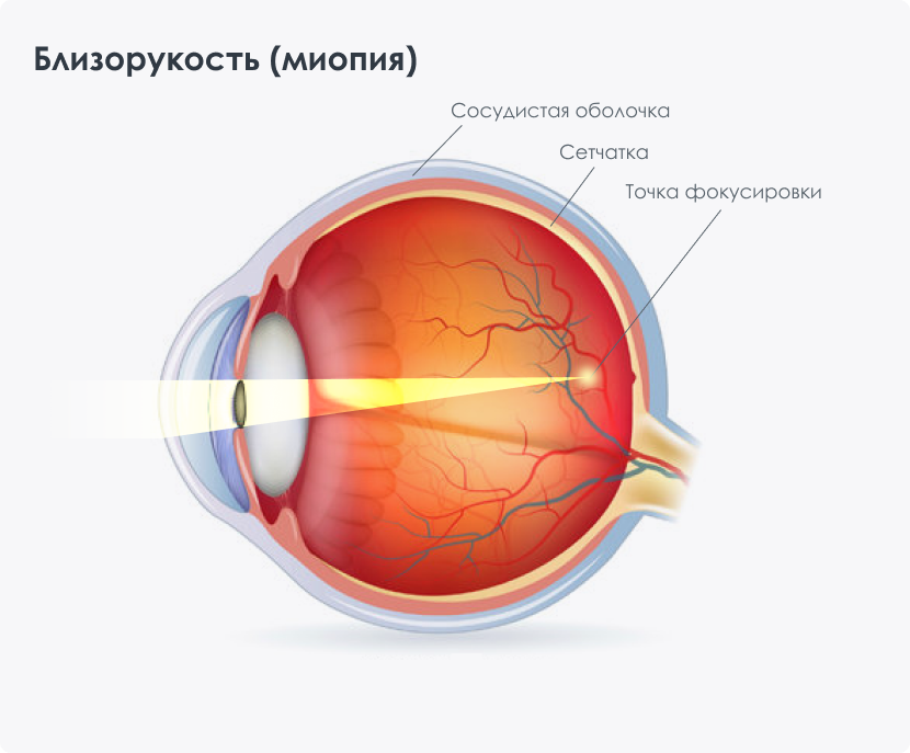 Миопия что это такое у детей. Миопия. Близорукость миопия. Мтопи. Миопия и здоровый глаз.