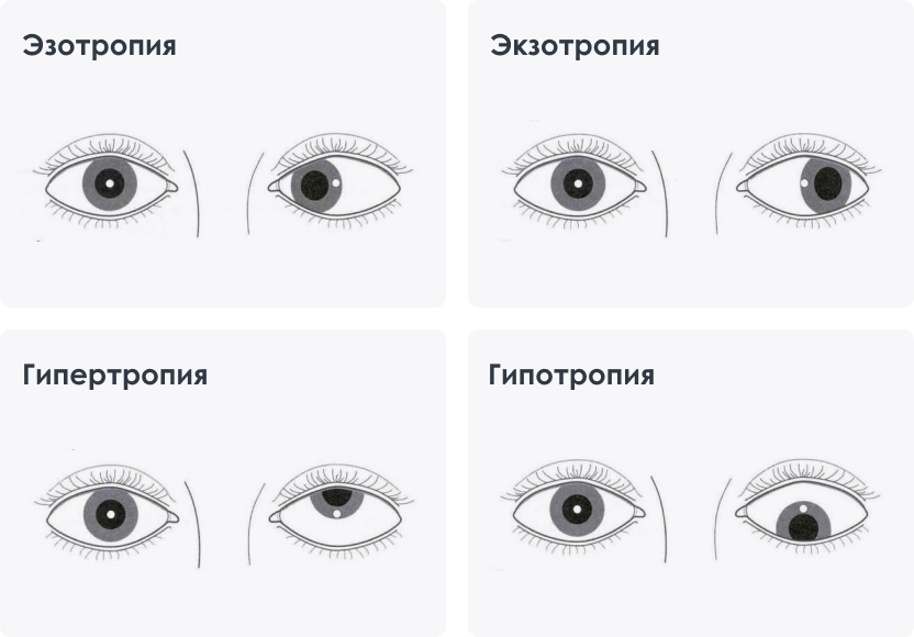 Лечение косоглазия у детей