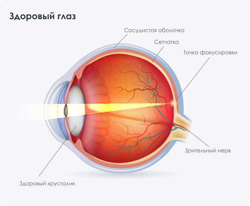 До и после операции по катаракте