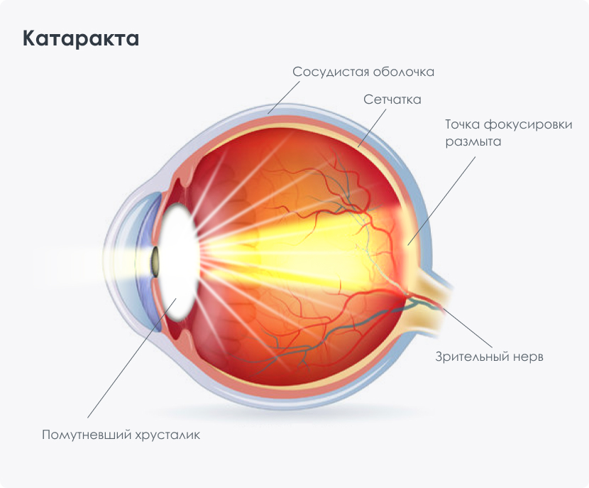 До и после операции по катаракте