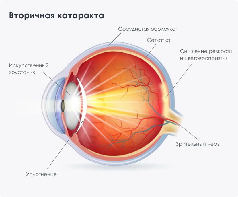 Замена хрусталика что нельзя делать после операции. Задняя капсула хрусталика. Вторичная катаракта после замены хрусталика. Задняя капсула хрусталика помутнение передней.