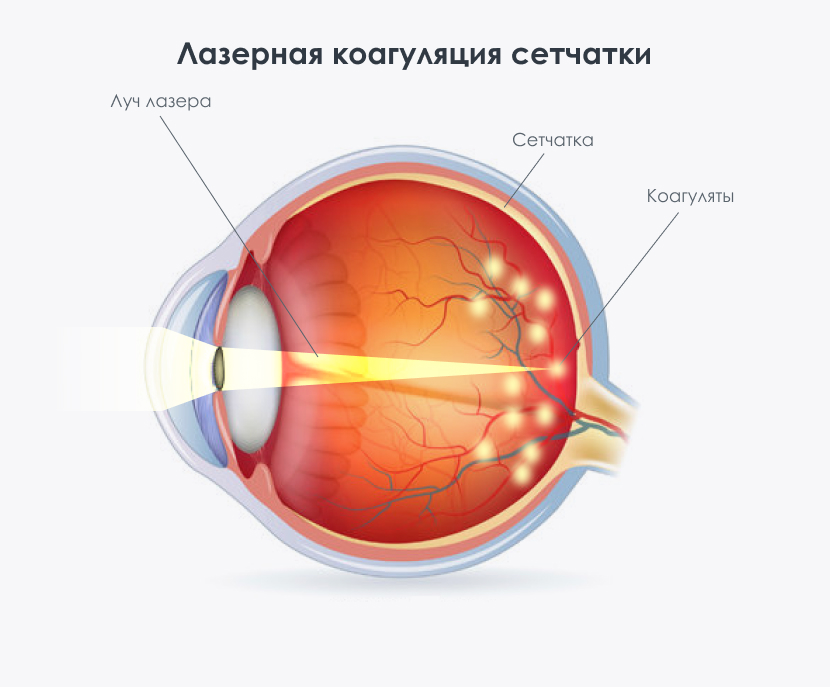 На сетчатке глаза формируется