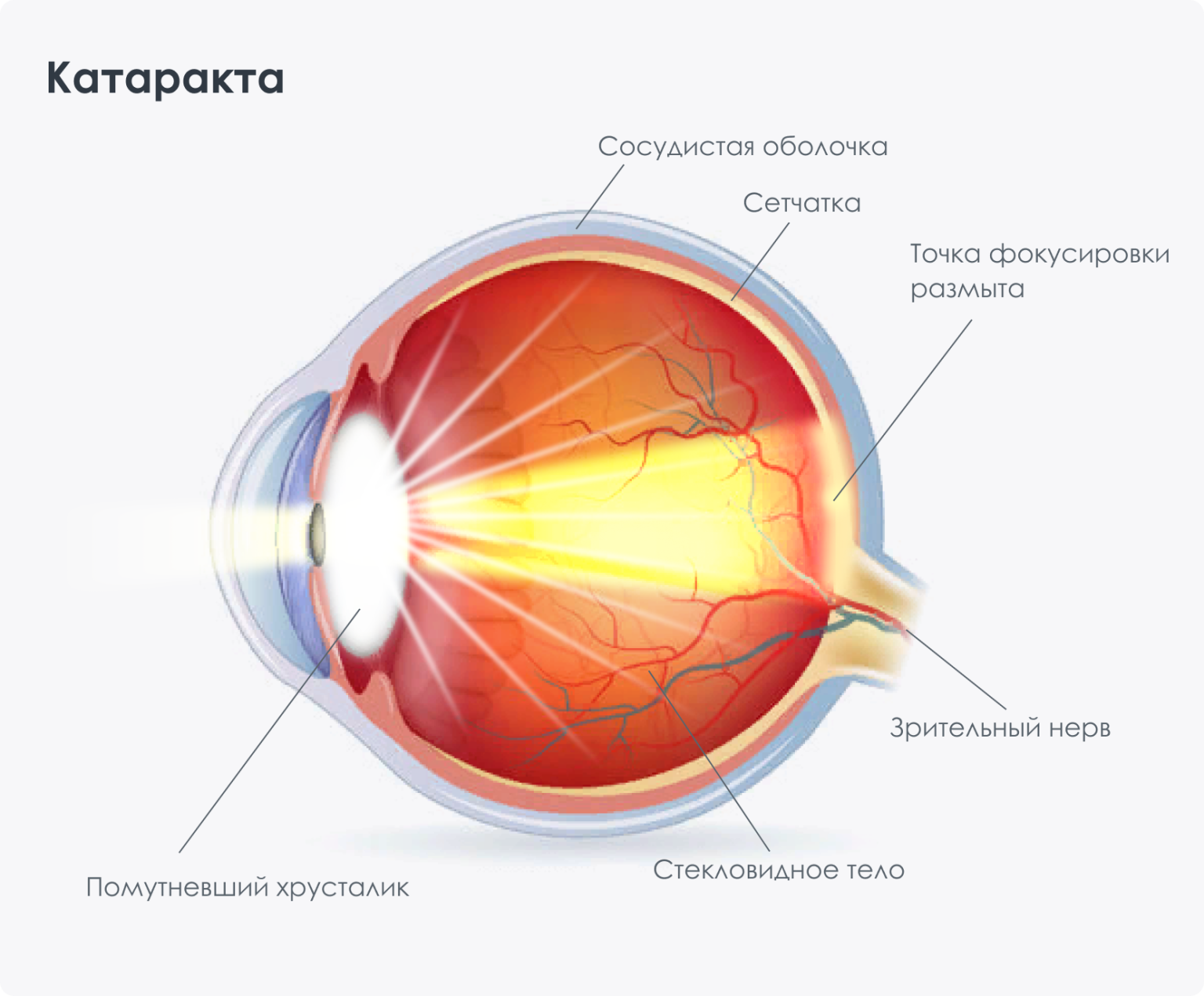 Пересадка Хрусталика Стоимость