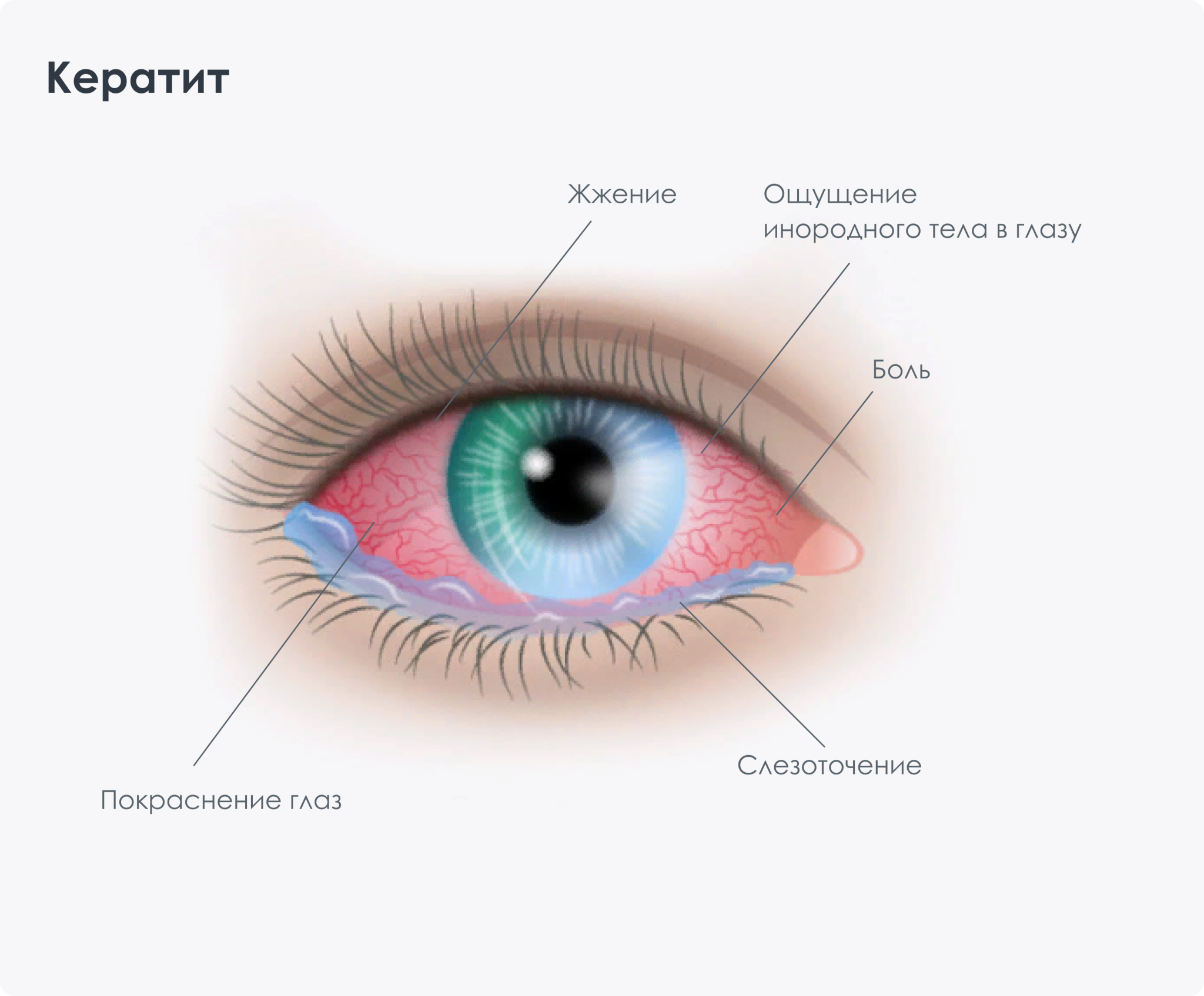 Кератит (воспаление роговицы)