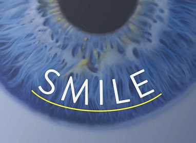 Технология SMILE – все о методе лазерной коррекции